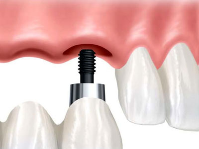 Implant Supported Dentures